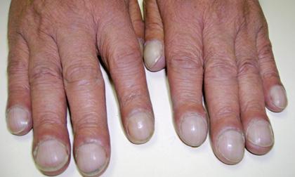 3 dấu hiệu trên móng tay tiết lộ bệnh tuyệt đối đừng bỏ qua