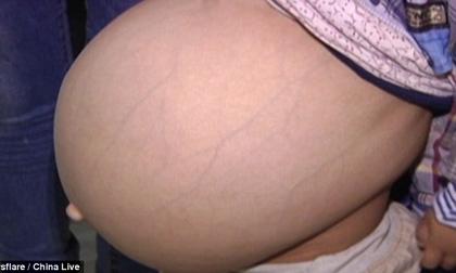 Bố mẹ 'té ngửa' khi biết nguyên nhân con trai 6 tuổi có bụng khổng lồ