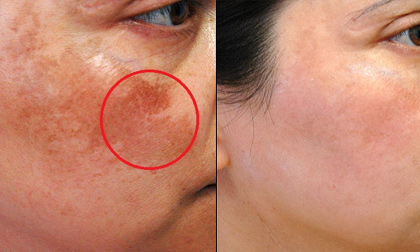 Xoa lát khoai tây mỗi sáng! Điều gì kỳ diệu gì sẽ xảy ra?