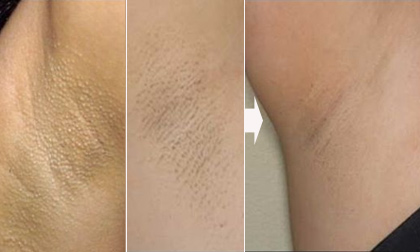 Nách 'da gà' sẽ đẹp trơn tru với 3 công thức siêu đơn giản