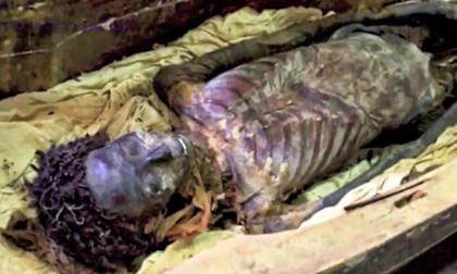 10 phương pháp trị bệnh 'điên rồ' nhưng có thật trong lịch sử