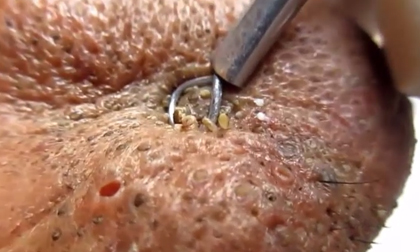 Rợn người xem cảnh nặn hàng trăm mụn đầu đen trên mũi người