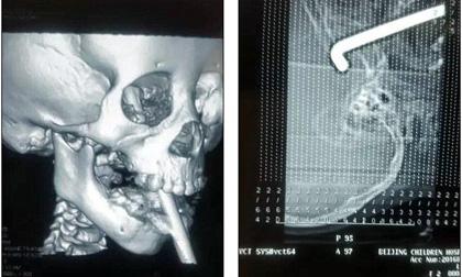 Bé gái 4 tuổi bị thanh sắt đâm vào miệng xuyên lên đầu vì vấp ngã