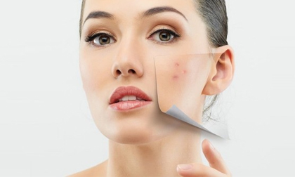 Thật hư liệu trình hết mụn sạch thâm trong 3 tuần?