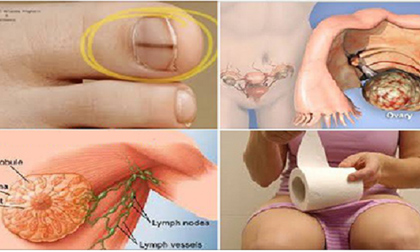 20 triệu chứng ung thư gây chết người hầu hết phụ nữ bỏ qua