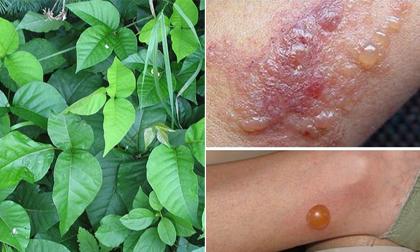 Hậu quả đáng sợ khi bị dị ứng cây thường xuân độc