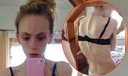 Nỗi đau bà mẹ người Anh có con sắp chết vì biếng ăn