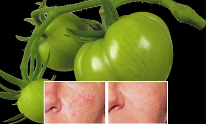 Cách chữa giãn mao mạch ở mặt