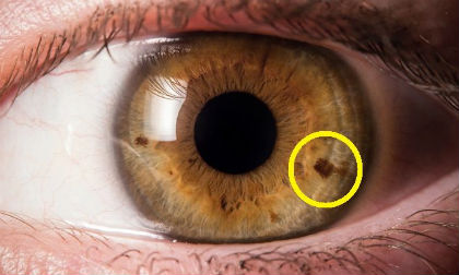 Dấu chấm đen trên mắt cảnh báo bệnh tật cực nguy hiểm