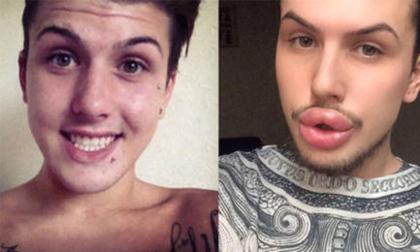 Chàng trai chi hơn 620 triệu đồng để phẫu thuật giống chị em Kim Kardashian