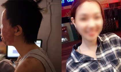 Nữ sinh từng bị tạt axit chấn động Sài Gòn: 'Em vẫn không hiểu mình đã làm gì sai...'