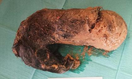 Lấy búi tóc nặng 1,3 kg trong bụng cô gái