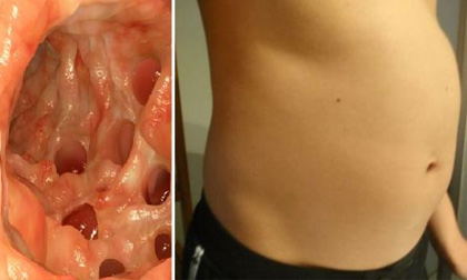 Dạ dày phình, đầy hơi: Dấu hiệu cảnh báo không nên bỏ qua