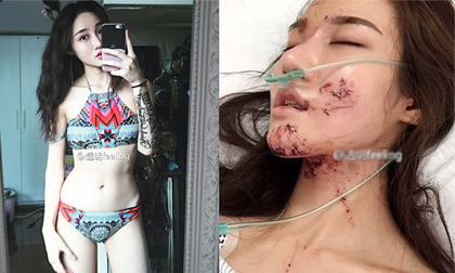 MC Trung Quốc 'nát mặt' vì tai nạn