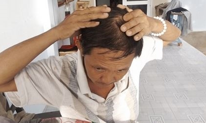 Chồng đổ nước sôi vào tai vợ: Lời tố ngược của các bên liên quan