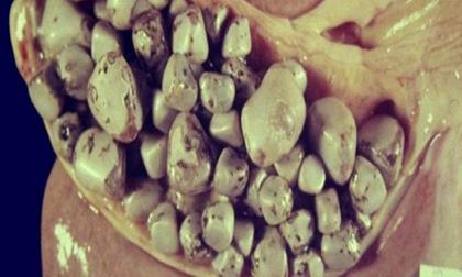 Công thức phá hủy 1000 viên sỏi mật chỉ trong 1 ngày