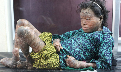 Cảnh đời bất hạnh của cô bé 13 tuổi mắc bệnh lạ khiến da khô như vảy cá