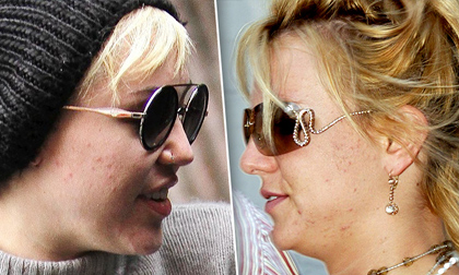 Sao và thảm họa mặt mụn 