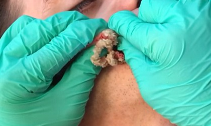 Rùng mình với clip xử lý khối u biểu mô trên má bệnh nhân