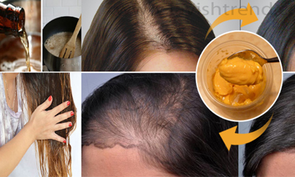 Tóc rụng hói đầu cũng mọc lại dày đẹp với công thức tự nhiên