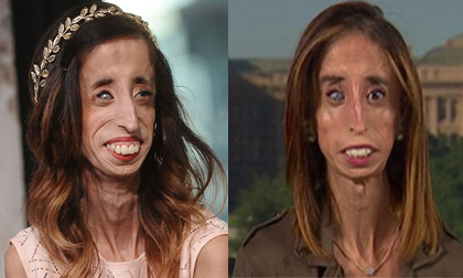 Sau 10 năm, phép màu đã đến với cô gái từng bị gọi là 'xấu xí nhất thế giới'