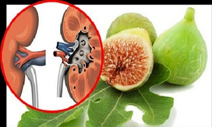 Công thức thần kỳ từ quả sung đánh bay sỏi thận 100% không lo tái phát