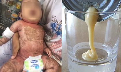 Con bị sốt rồi biến chứng suy dinh dưỡng nặng do mẹ cho uống sữa đặc 
