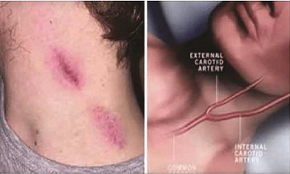 Cắn yêu - Hành động lãng mạn nhưng có thể giết người bạn yêu thương