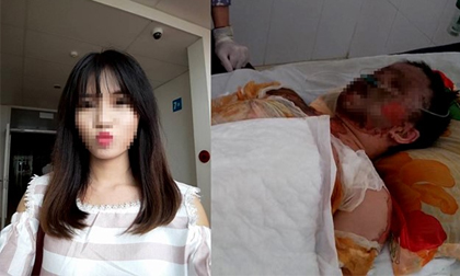 Cô gái xinh đẹp bị bỏng toàn thân đã tử vong