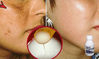 Loại bỏ vế ố, thâm sạm trên da với công thức siêu rẻ