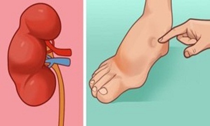 1 tháng trước khi đột quỵ, cơ thể sẽ xuất hiện những dấu hiệu này