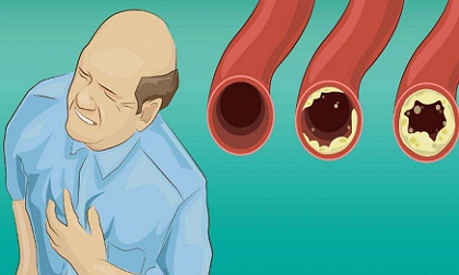 Thực phẩm vàng đặc trị thông tắc động mạch tự nhiên và chống nhồi máu cơ tim