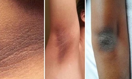 Loại bỏ vùng da sậm màu ở cổ, nách, khuỷu tay bằng cách vô cùng đơn giản