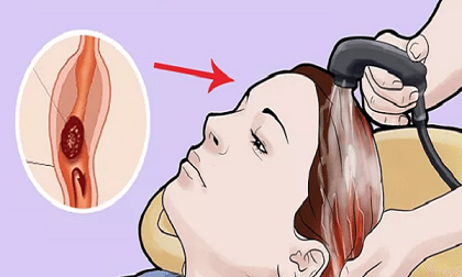 Gội đầu ở bồn tiệm cắt tóc có thể gây đột quỵ