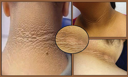 Nếu thấy trên cổ con xuất hiện vòng tròn sậm màu, hãy đi khám ngay trước khi quá muộn