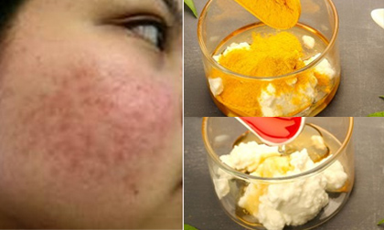 'Đá bay' mụn, nếp nhăn, sẹo và quầng thâm với thần dược bột nghệ