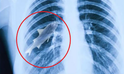 Rùng rợn chuyện những sinh vật sống 'làm tổ' trong cơ thể người