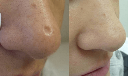 Loại bỏ sẹo lõm giúp làn da mịn màng chỉ tốn 10 giây chuẩn bị mỗi ngày