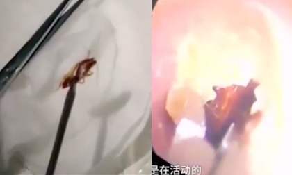 'Dựng tóc gáy' xem clip gắp gián đang 'ngoe nguẩy' trong tai người phụ nữ