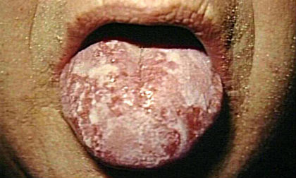 Những căn bệnh lây qua đường tình dục có thể giết chết bạn