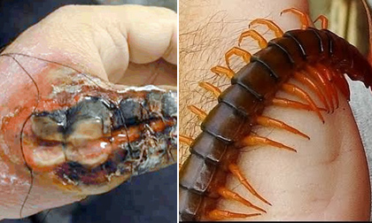 Cách sơ cứu và chữa trị khi bị rết cắn