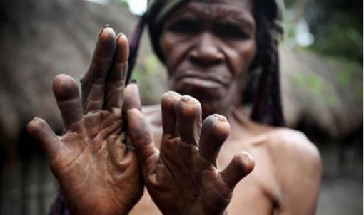 Bộ tộc hàng loạt phụ nữ cụt đầu ngón tay