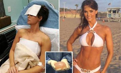 Cựu người mẫu Playboy tháo bỏ túi độn ngực vì bị đầu độc