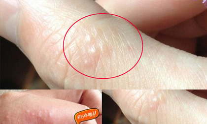 Mọc chùm mụn nước li ti ở ngón tay báo hiệu điều gì?
