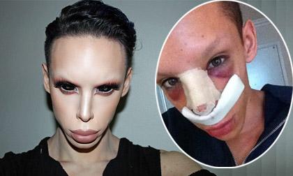 Chàng trai phẫu thuật 110 lần để thành người ngoài hành tinh