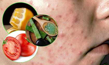 8 cách làm giảm mụn trứng cá tự nhiên, siêu rẻ