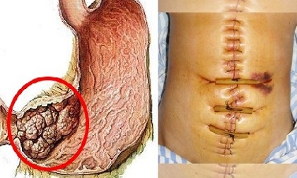 5 dấu hiệu trước khi bị ung thư dạ dày bạn buộc phải biết, chậm là hối tiếc cả đời