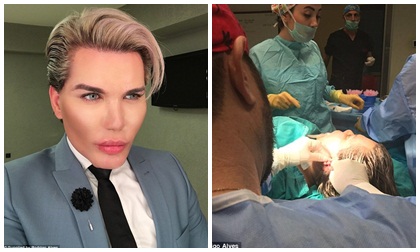 Chàng trai mê làm 'búp bê sống' tiến hành ca phẫu thuật lần thứ 57