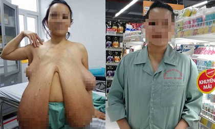 Hình ảnh mới nhất về người phụ nữ có bộ ngực khổng lồ sau khi phẫu thuật