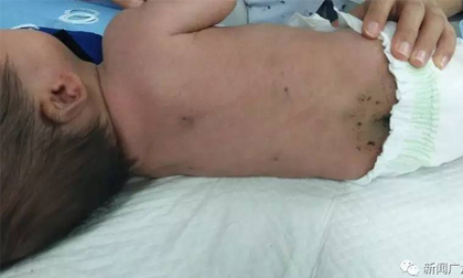 Bé sơ sinh 40 ngày tuổi bị đâm 30 mũi kim vì bà ngoại tin bài thuốc dân gian 'chích máu'